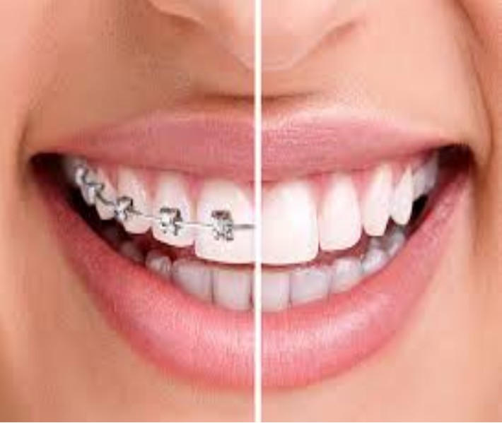 Before and after dental braces Adelaide results