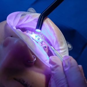 Modern dental braces Adelaide treatment in progress